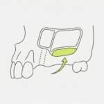 Синус-лифтинг перед имплантацией в Москве: гайд 2026