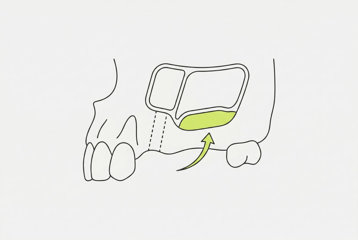 Синус-лифтинг перед имплантацией в Москве: гайд 2026