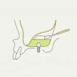 Синус-лифтинг перед имплантацией в Москве: гайд 2026