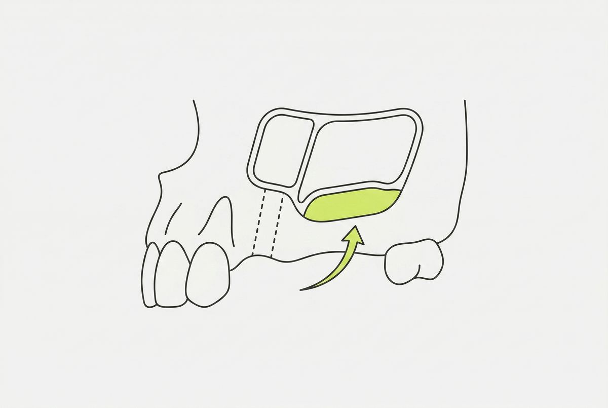 Синус-лифтинг перед имплантацией в Москве: гайд 2026